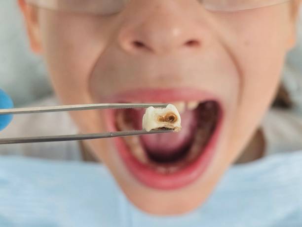 Best Dental Abscess Treatment in Bnchard, LA